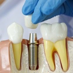 Dental Implants - Replace Missing Teeth Bellevue, WA